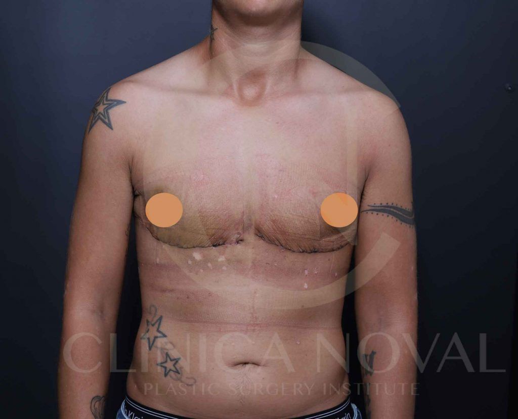 trans hombre mastectomia