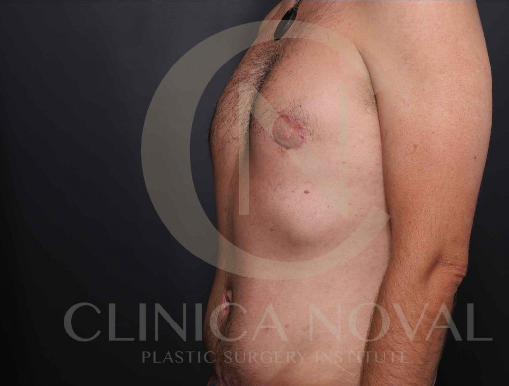 ginecomastia-clinica-noval